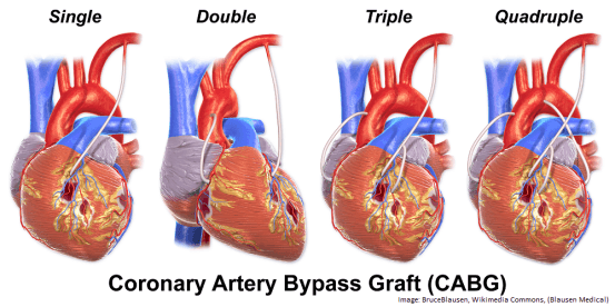 Coronary Artery Bypass Graft types