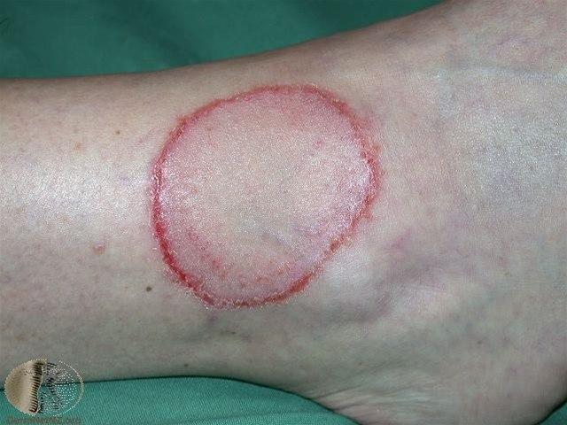 Fotoet viser ringorm