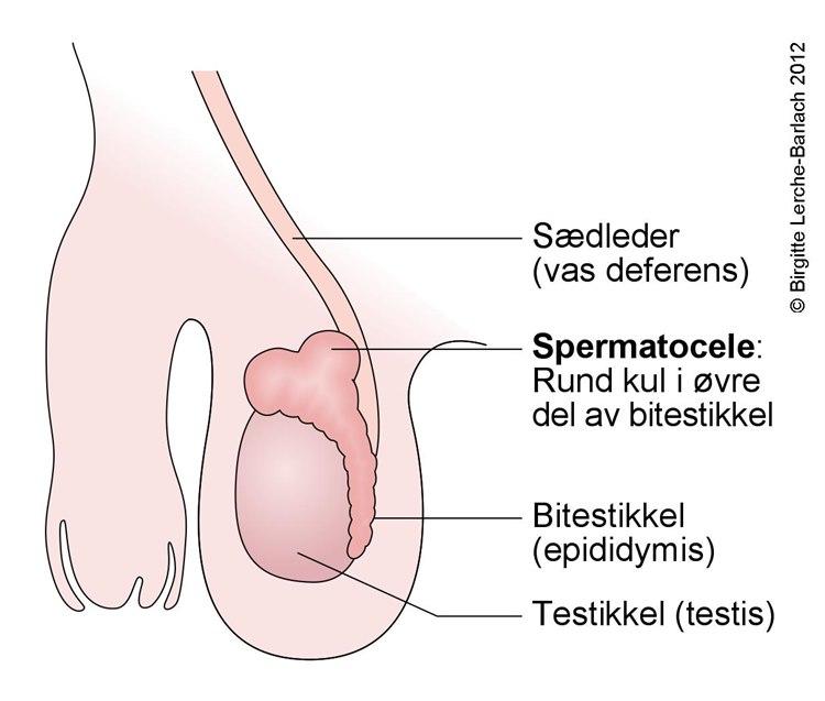 Scrotum - spermatocele