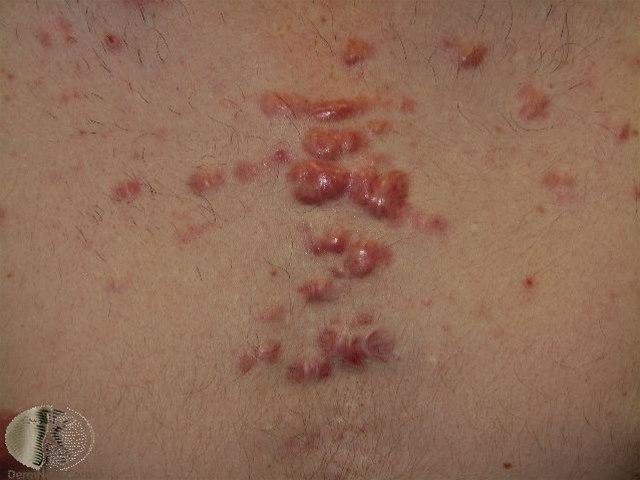 Fotoet viser akne, arr