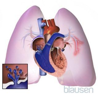 Pulmonær hypertensjon