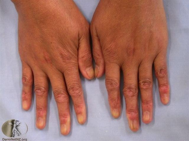 Fotoet viser nærbilde av to hender med systemisk sklerose