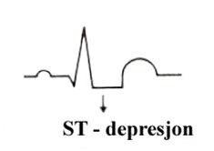 Senket ST-segment