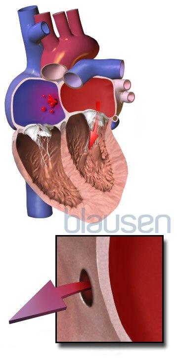 Hull mellom forkammerene (ASD)