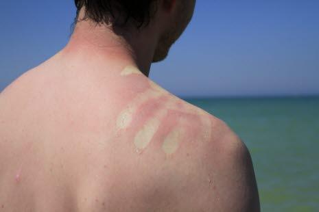 Nærbilde av en solbrent skulder med et hvit håndmerke