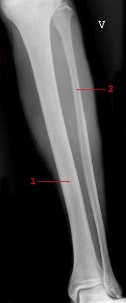 Normalt røntgenbilde av leggen