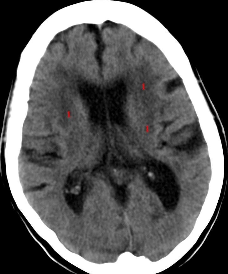Cerebrale multiinfarkt (CT)