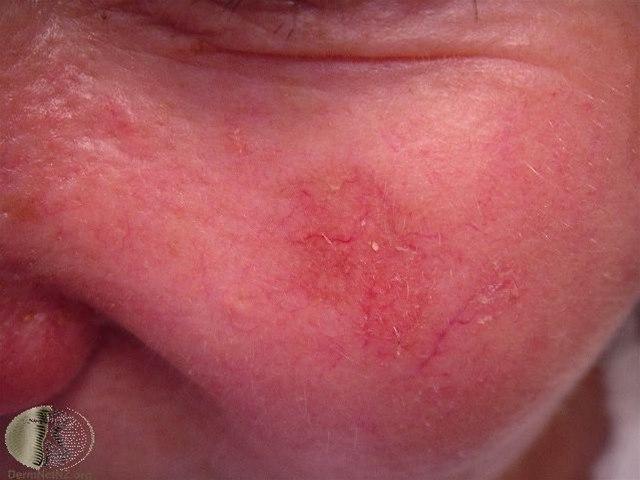 Fotoet viser aktinisk keratose, flate