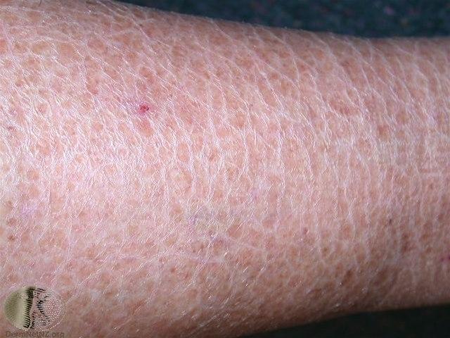 Fotoet viser iktyose