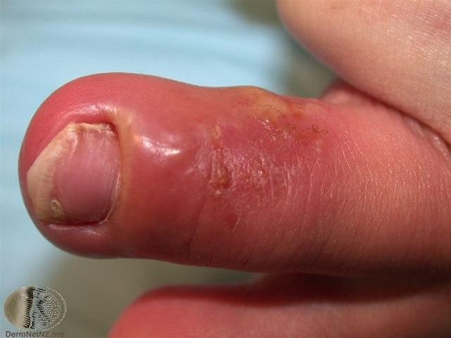 Fotoet viser herpes simplex, Whitlow