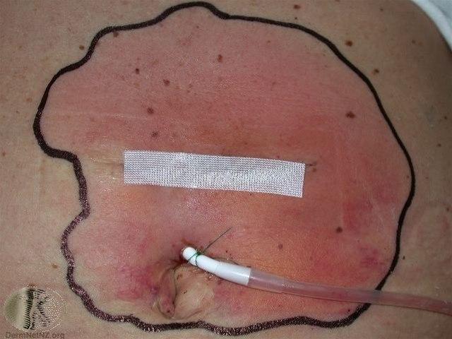 Fotoet viser cellulitt (GAS)