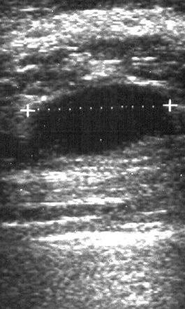 Ultralyd mamma, cyste