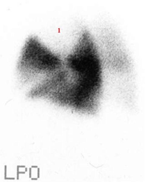 Lungeemboli, scintigrafi