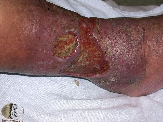 Fotoet viser leggsår, kronisk venøst