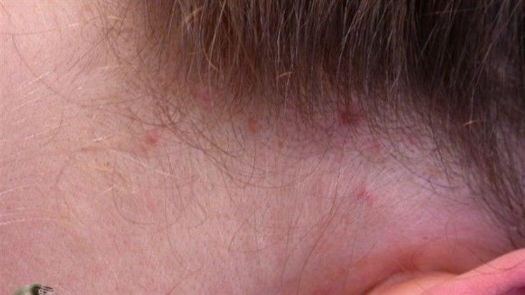 Fotoet viser lusbitt bak øret