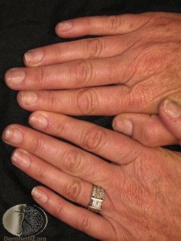 Fotoet viser psoriasis på negl