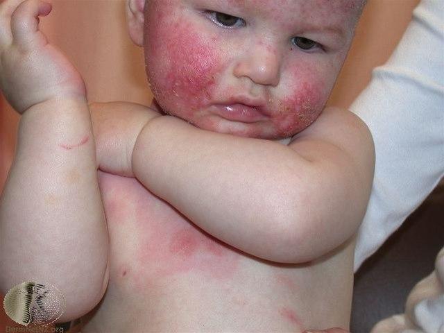 Fotoet viser atopisk eksem, baby