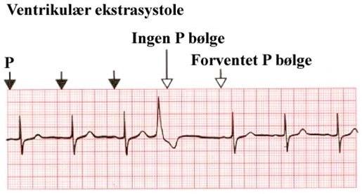 Ventrikulær ekstrasystole (B)