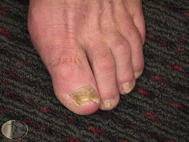 Fotoet viser nærbilde av en fot med neglesopp på alle tærne