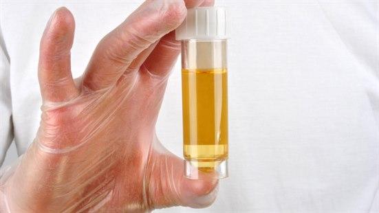 Illustrasjonsfotoet viser et nærbilde av en hånd som holder en urinprøve