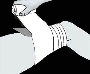 Lår, trykkbandasje bilde#1