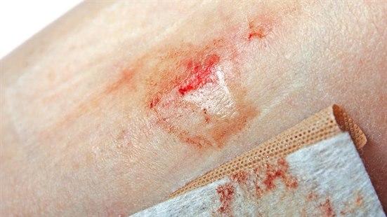 Nærbildet av et skrubbsår på huden til en person. 