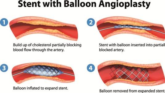 Angioplastikk og stenting
