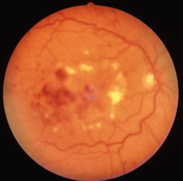 Retinopati