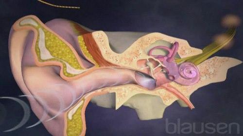 Cochlea implant