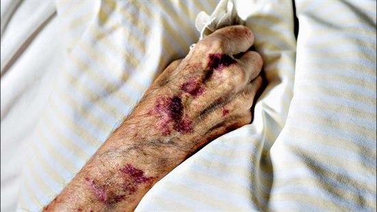 En pasients hånd med flere blåmerker som ligger på et sengetrekk.