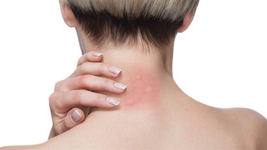 Illustrasjonsfoto av tre røde myggstikk på nakken til en lys kvinne.