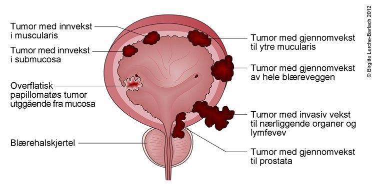 Urinblære med svulster