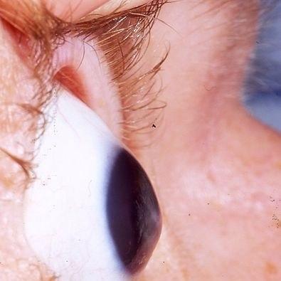 Courtesy of Indiana University School of Medicine, Department of Ophthalmology