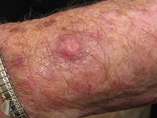 Fotoet viser keratoakantom, arm