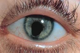 Coloboma
