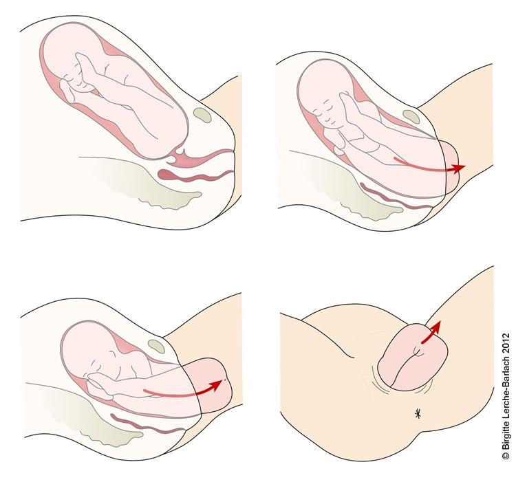 Illustrasjonstegningen viser stadier i en setefødsel