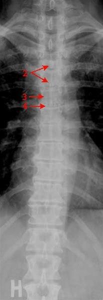 Toracalcolumna, front