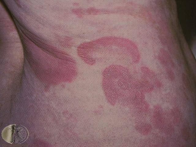 Fotoet viser mycosis fungoides, plakk