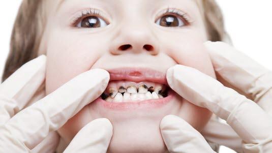Barn med tannråte
