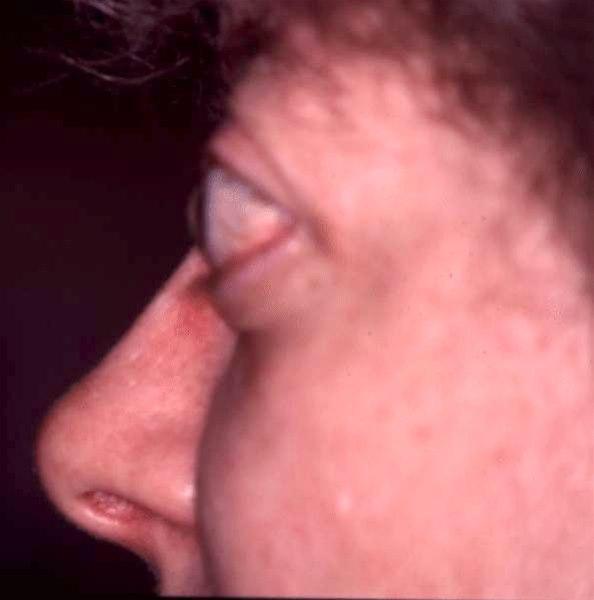 Exoftalmus, side