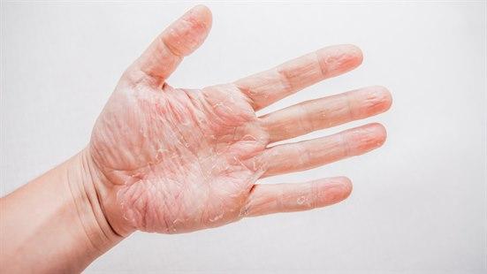 hand eczema
