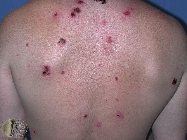 Fotoet viser pemfigus vulgaris