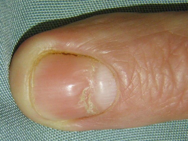 Fotoet viser nærbilde av negl med transverse lineære lesjoner