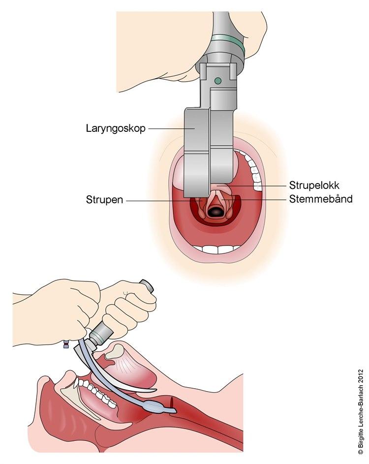 Laryngoskopi
