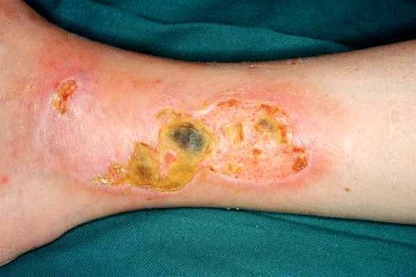Venøst leggsår, tørt