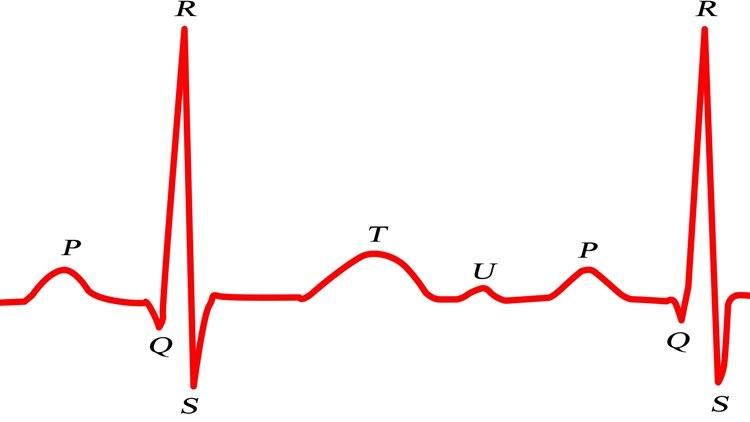 EKG