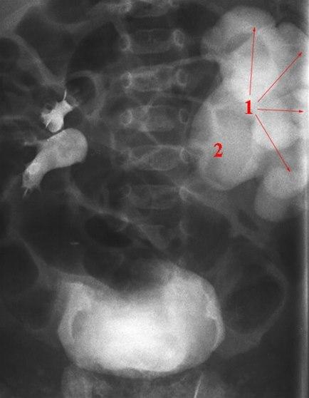 Overgangs-stenose (urografi)