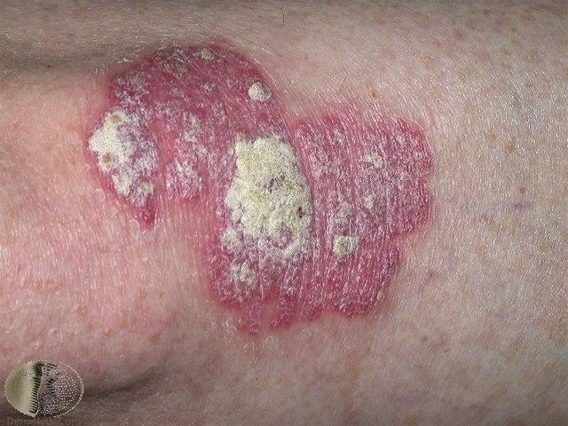 Fotoet viser psoriasis, plakk