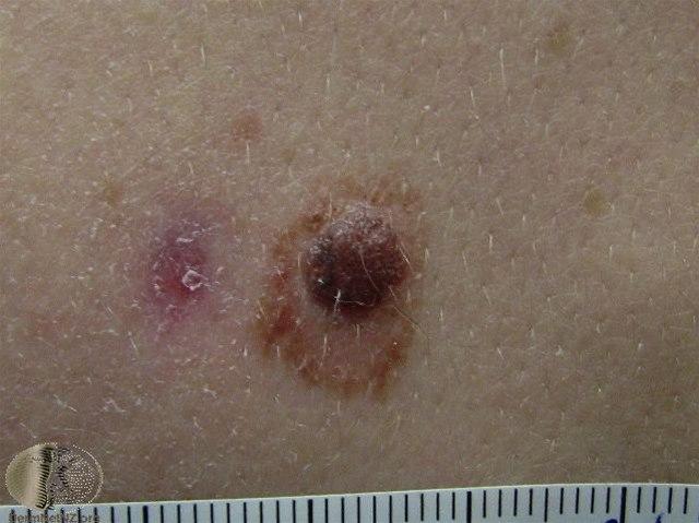 Fotoet viser nevus, atypisk