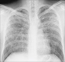 Sarkoidose i lungene